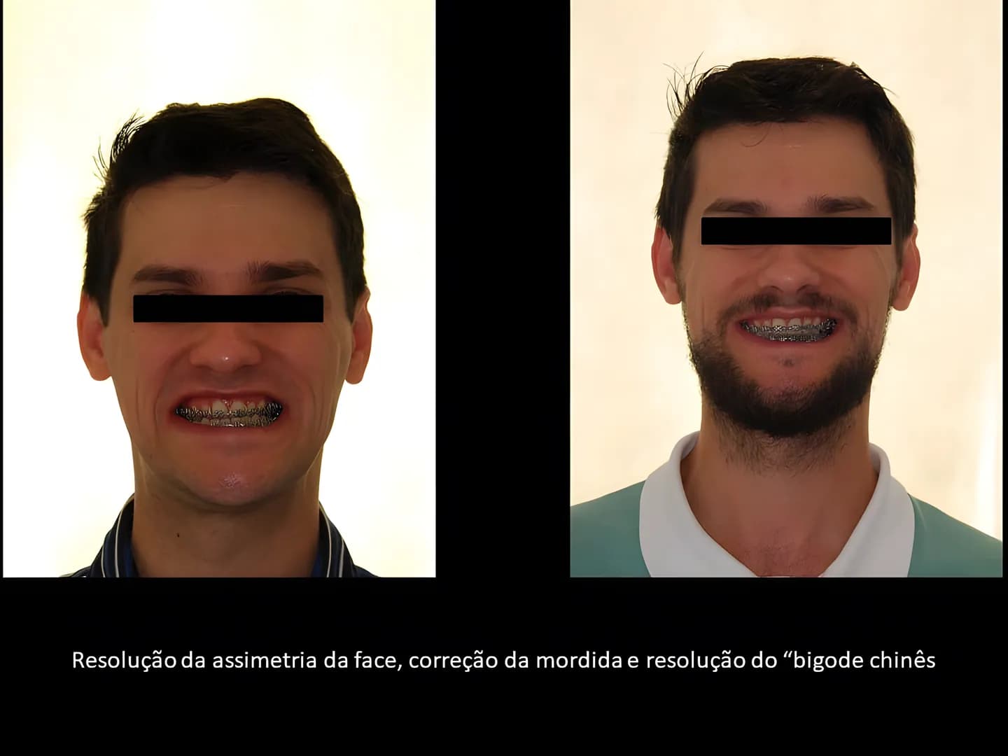 Antes e depois: Resolução da assimetria da face, correção da mordida e do “bigode chinês”.