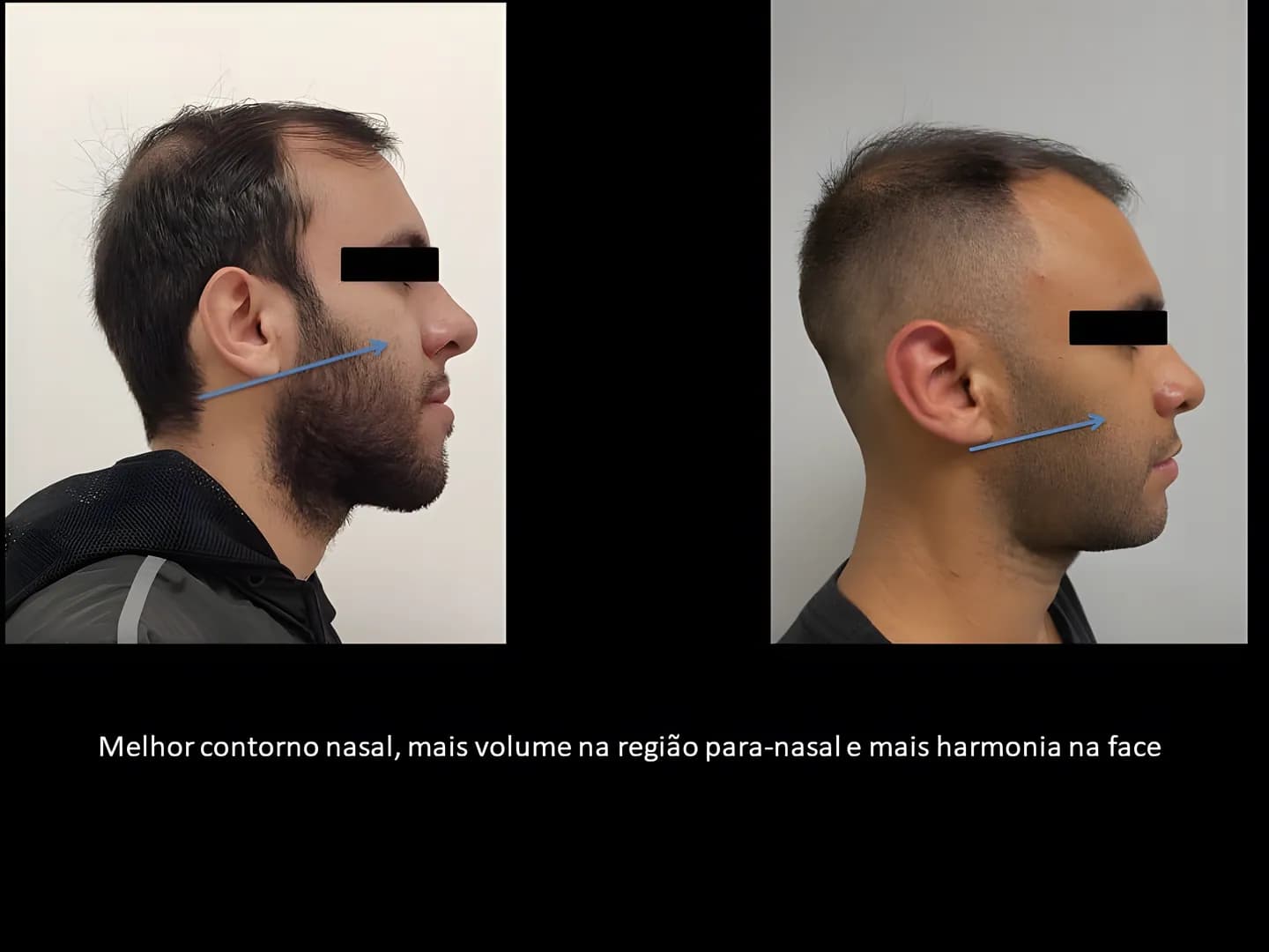 Antes e depois: Melhor contorno nasal, mais volume na região paranasal e mais harmonia na face.