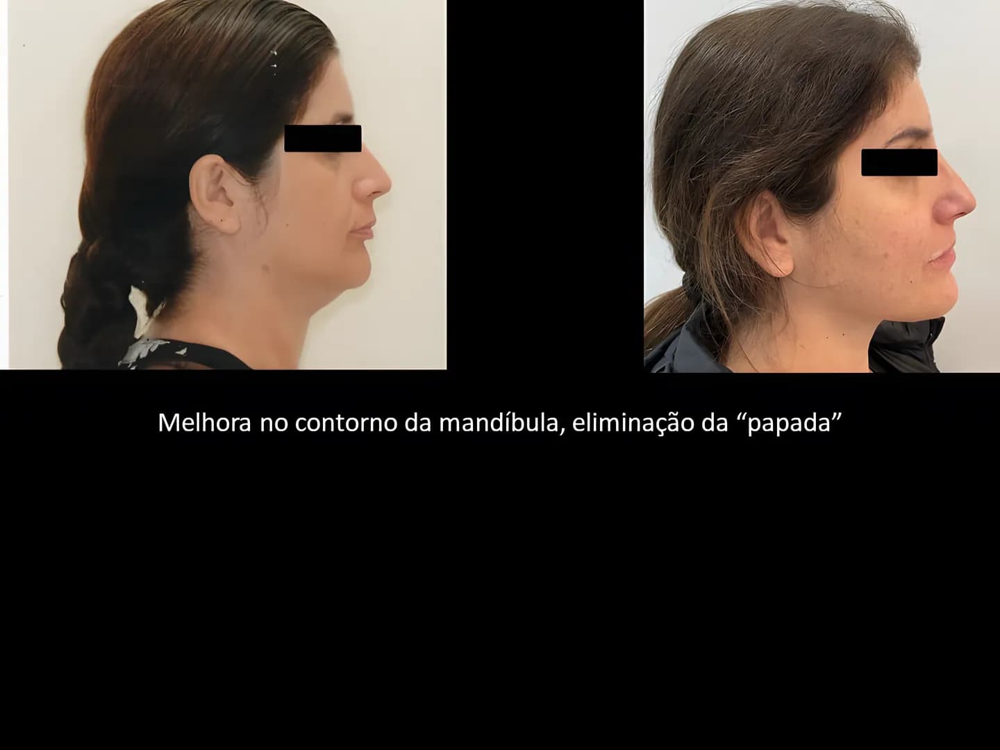 Antes e depois: Melhora do contorno da mandíbula e eliminação da “papada”.