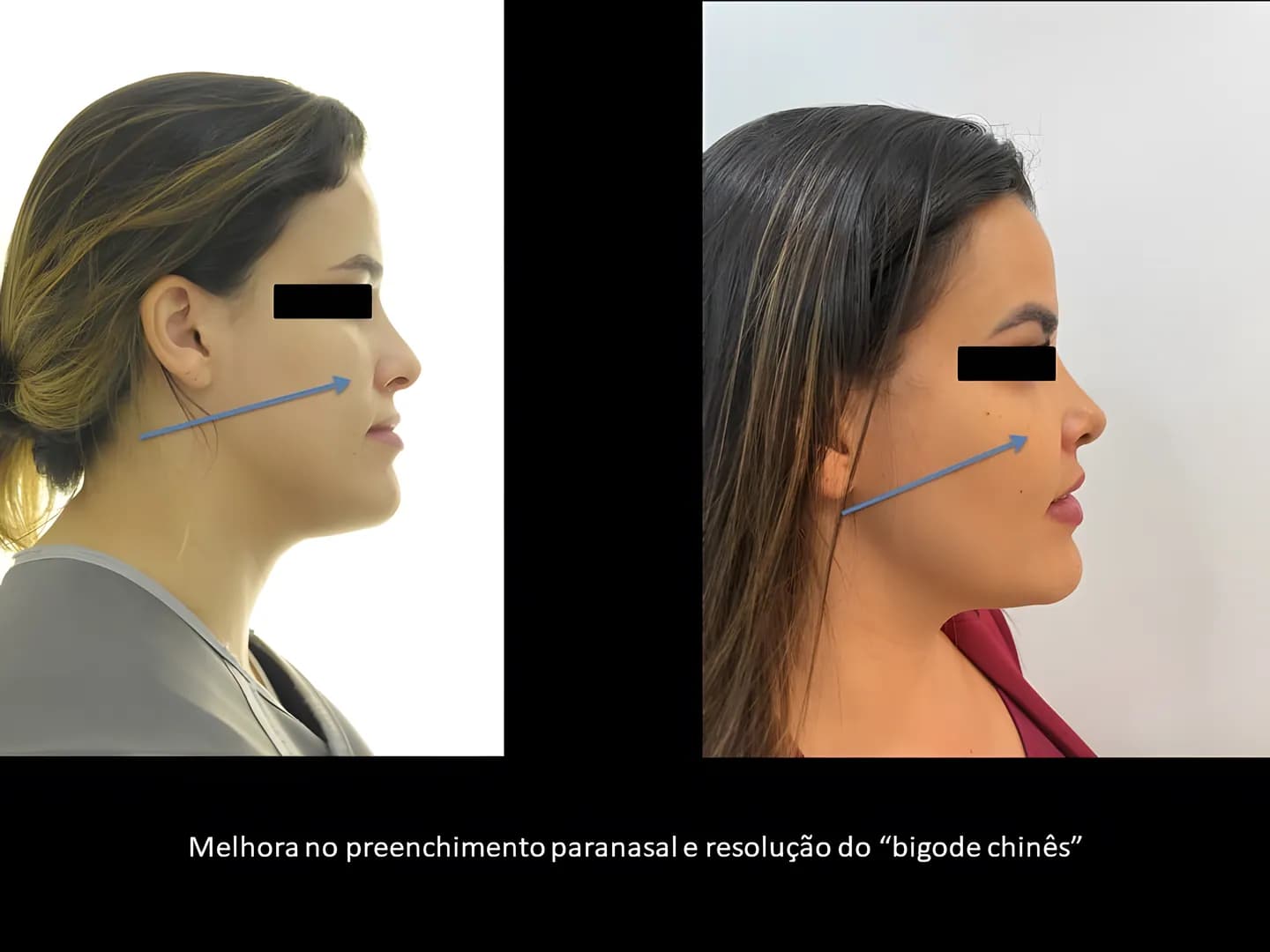 Antes e depois: Melhora do preenchimento paranasal e resolução do “bigode chinês”.
