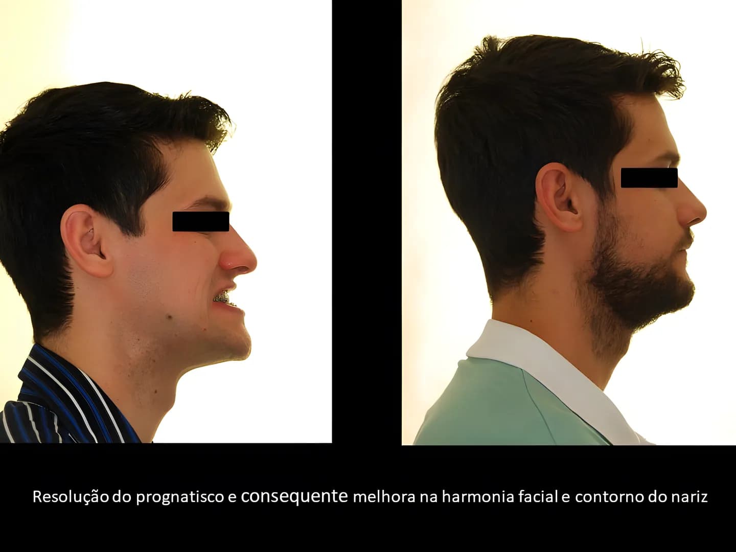 Antes e depois: Resolução do prognatismo, com melhora da harmonia facial e do contorno do nariz.
