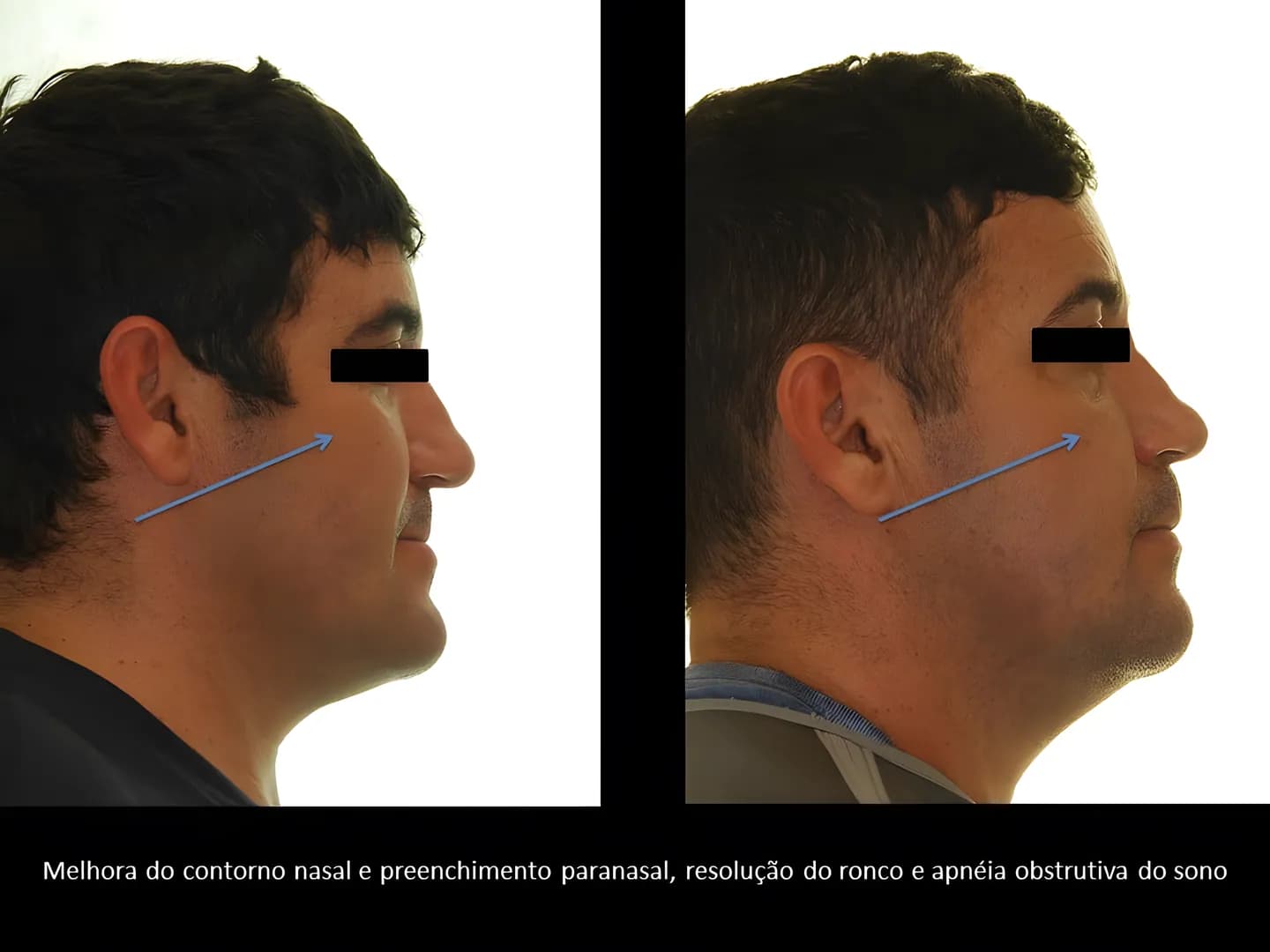 Antes e depois: Melhora do contorno nasal e preenchimento paranasal, com resolução do ronco e da apneia obstrutiva do sono.