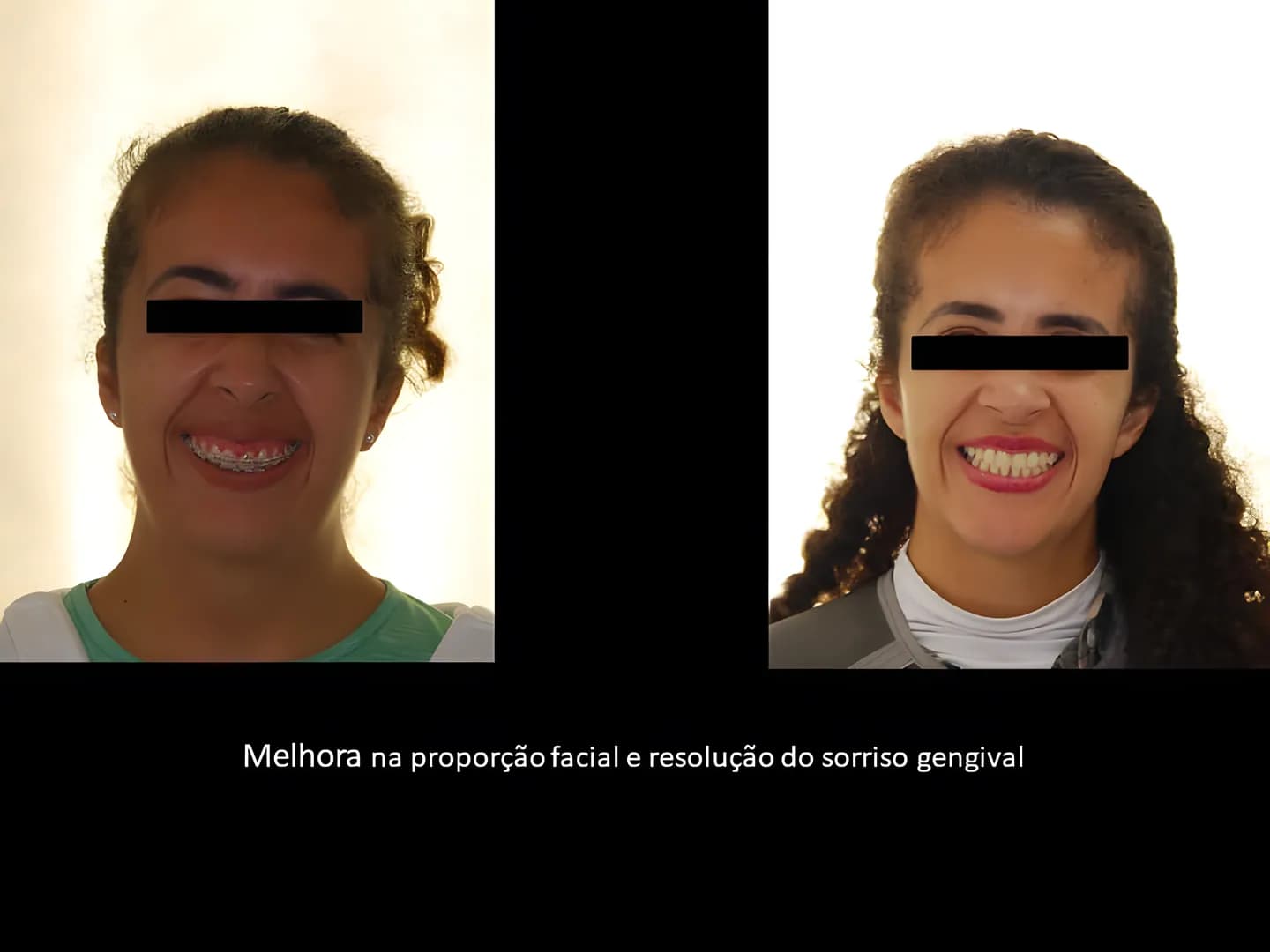 Antes e depois: Melhora da proporção facial e resolução do sorriso gengival.