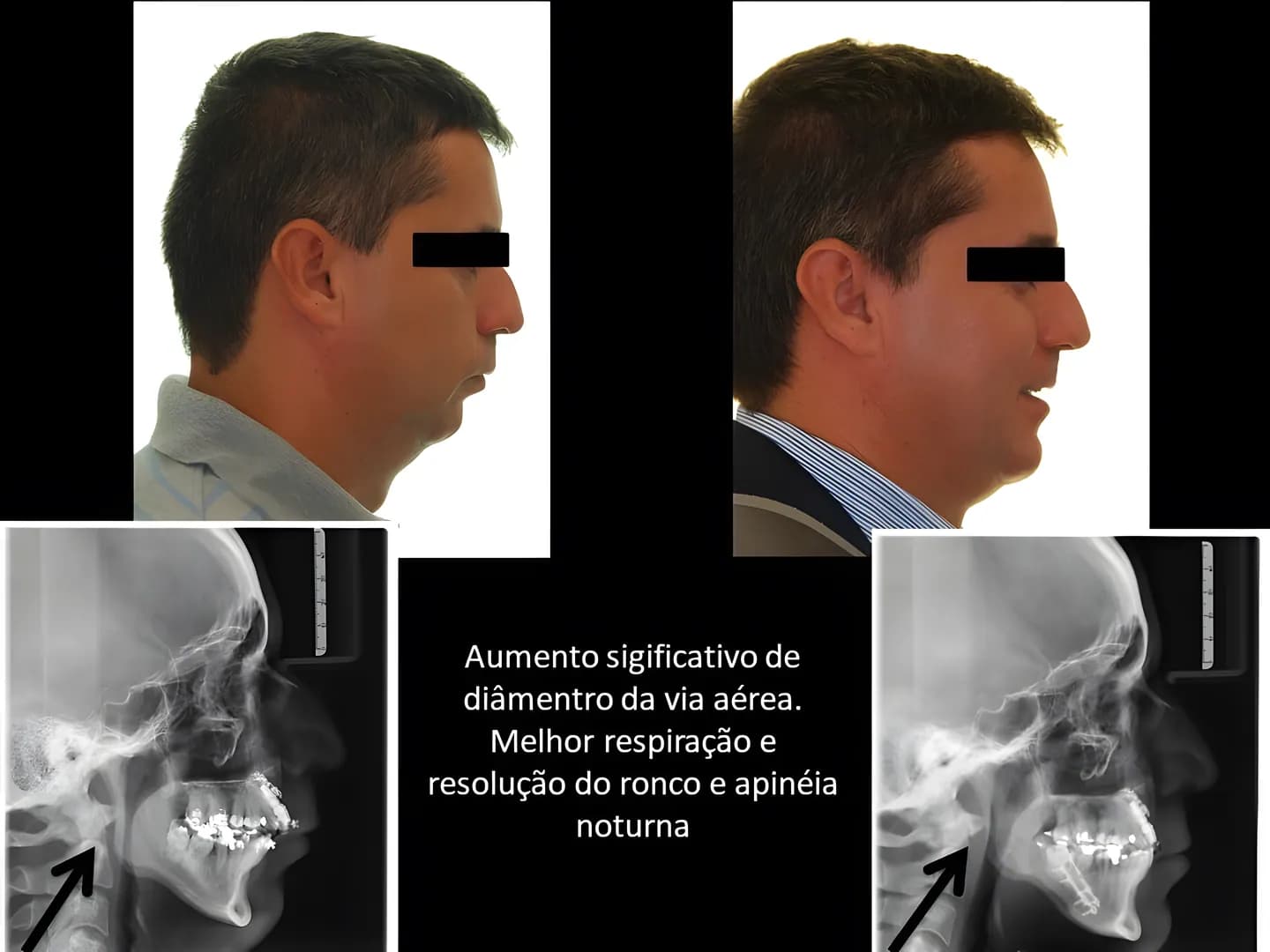 Antes e depois: Aumento significativo do diâmetro da via aérea: melhor respiração e resolução do ronco e da apneia noturna.